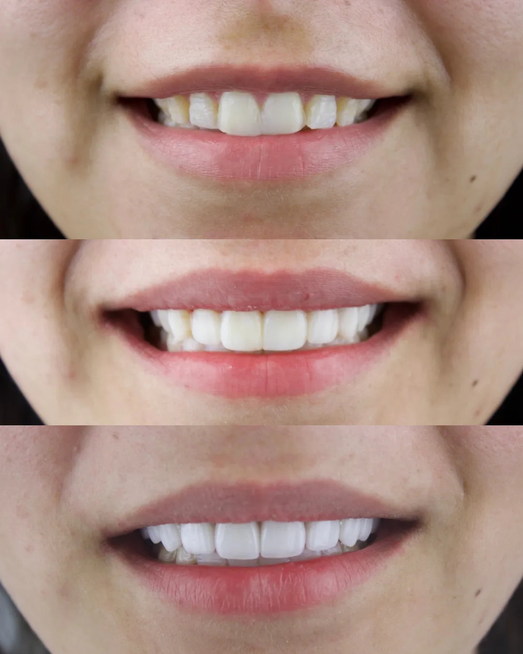 Antes y después — carillas dentales Aura Dental Spa Tijuana